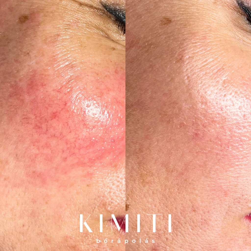 kimiti_borapolas_kozmetika_siofok_rosacea